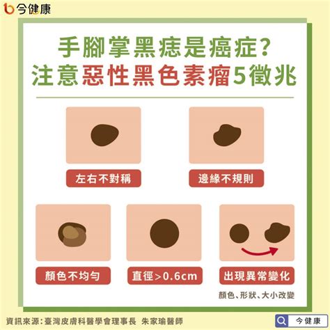 手長黑斑|手腳掌有黑痣是癌症？醫：5徵兆注意黑色素瘤｜東森 